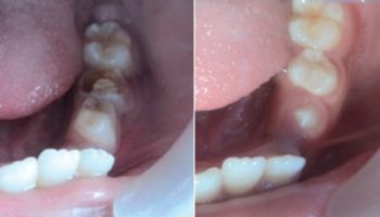 Лечение пульпита в клинике Dr.Teeth