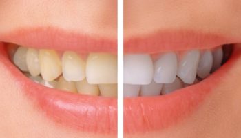 Отбеливание зубов в клинике Dr.Teeth